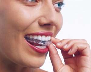 Hoofdstraat Overzicht Kruiden Een onzichtbare beugel – Kliniek voor Tandheelkunde